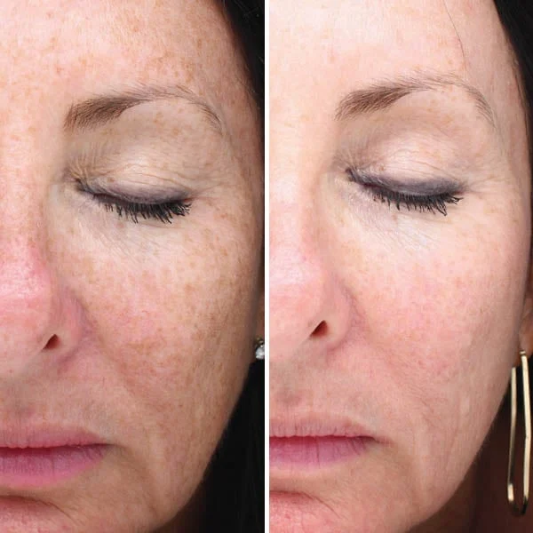 BBL Forever Young before and after results - skin tone improvement