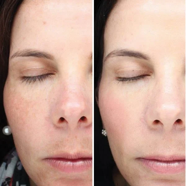 BBL Forever Young before and after results - pigmentation reduction