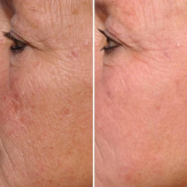BBL Forever Young before and after results - sun damage treatment