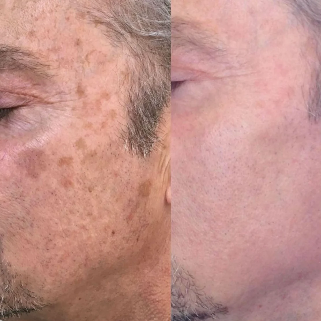 BBL Forever Young before and after results - age spot removal