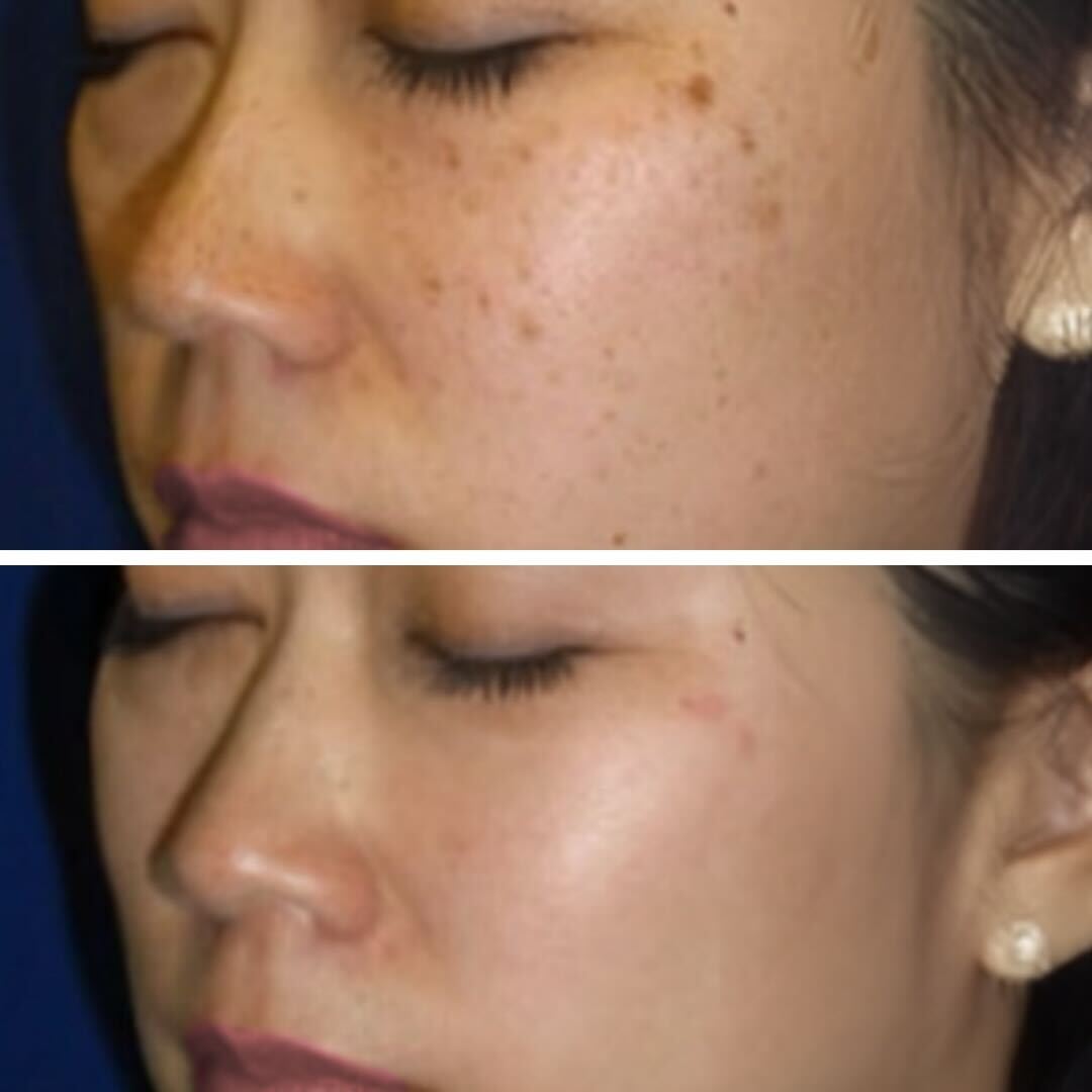 BBL before and after results - facial spot removal