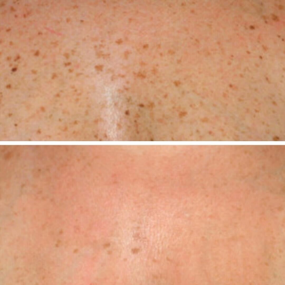 BBL before and after results - sun spot reduction on skin