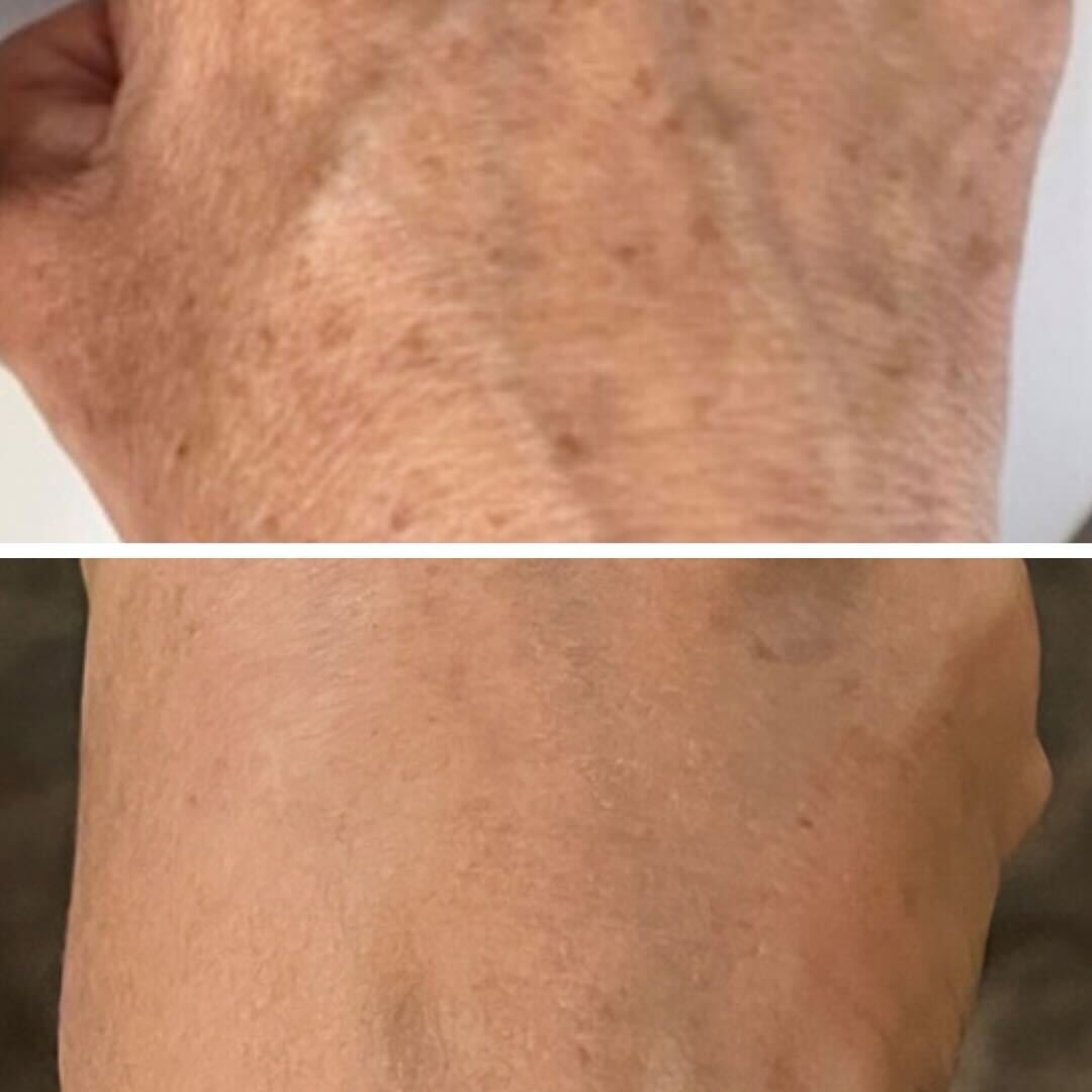 BBL before and after results - hand spot treatment