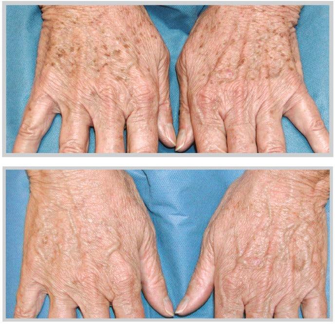 BBL before and after results - hand rejuvenation