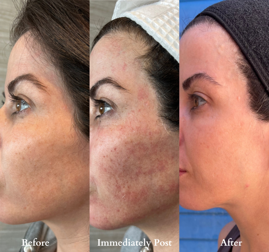 BBL Hero before, immediately post, and after treatment results